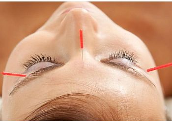 Nice Acupuncture image 3 Nice Acupuncture Nice Acupuncture image 3